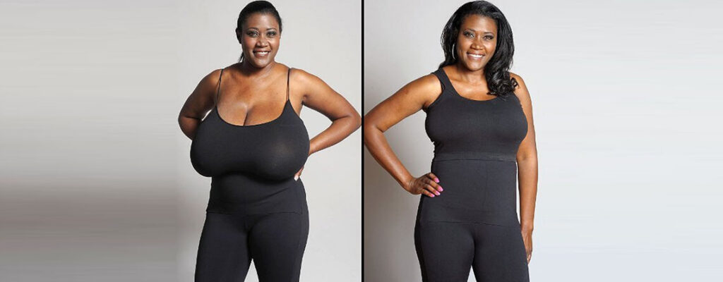 A Comprehensive Guide to Breast Reduction Surgery