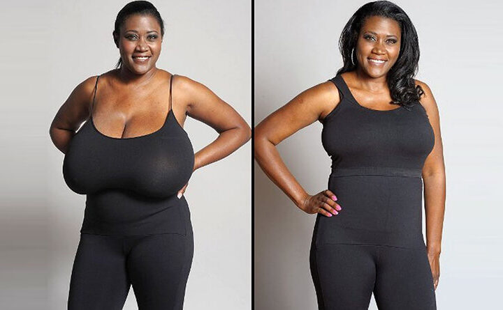 A Comprehensive Guide to Breast Reduction Surgery