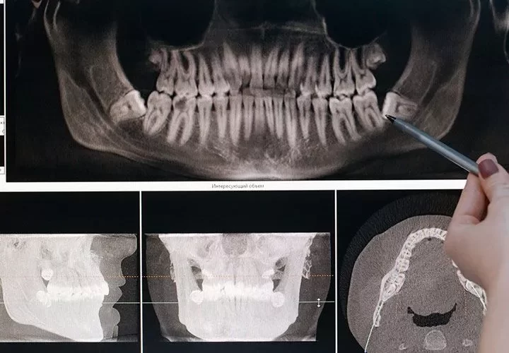 Gingival Depigmentation