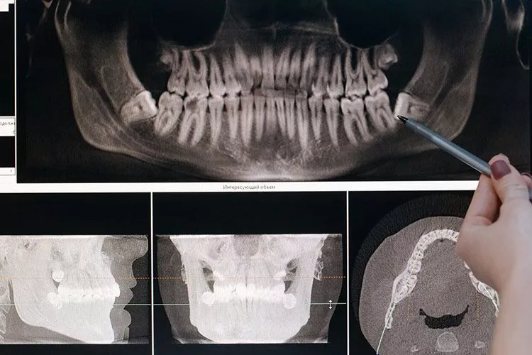 Gingival Depigmentation